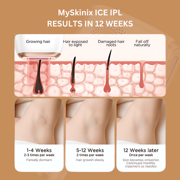 MySkinix Ice Cool Ipl Laser Device - MySkinix