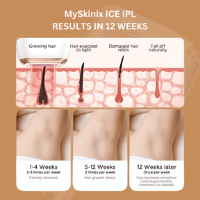 MySkinix Ice Cool Ipl Laser Device - MySkinix